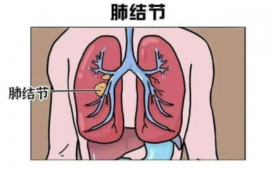 精准清除6个结节 | 德州市第二人民医院胸外科三维重建技术助患者摆脱早癌