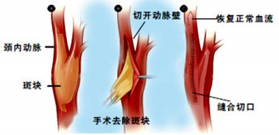 取栓+矫正 山大齐鲁医院德州医院脑血管外科手术再次填补我市空白