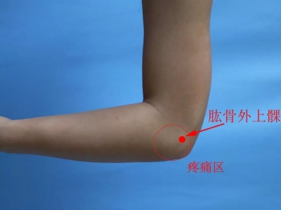 中医日间病房 | 中医助力“网球肘”患者重获健康