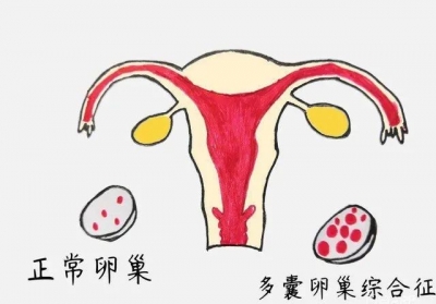 多囊卵巢综合征引发不孕怎么办？德州市中医院妇产科专家为您解答