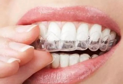 隐形矫正 | 外观与实用兼备的牙齿矫正新选择