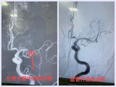 老人突发脑梗，乐陵人民医院颅内支架取栓打开生命通道