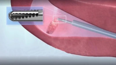 “吸尘器”解决宫内“多肉” | 德州市妇幼保健院“微无创”宫腔镜新技术