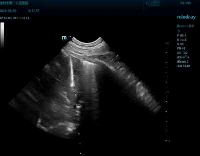 德州市第二人民医院：超声穿刺穿越纵隔“禁区”完成标本采样