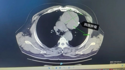 齐鲁医院德州医院：三个“钥匙孔”巧妙切除巨大胸腺瘤