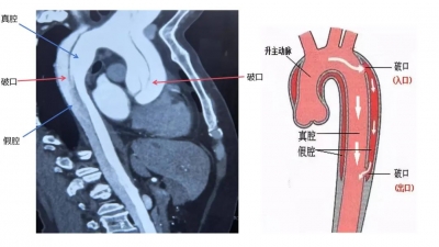女子大年初二突患凶险疾病，死亡率达90%！德州上演生死极限8小时！