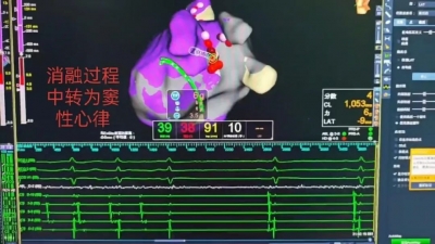齐鲁医院德州医院成功完成高难度射频消融术