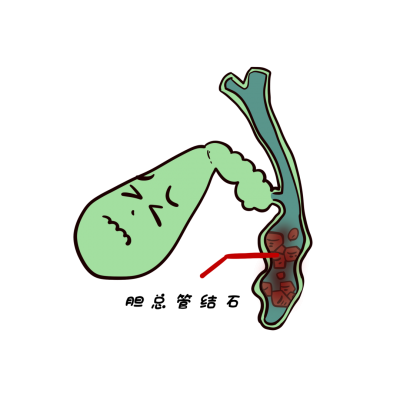 齐鲁医院德州医院多学科联手救治高龄胆总管结石+极重度肺功能障碍患者